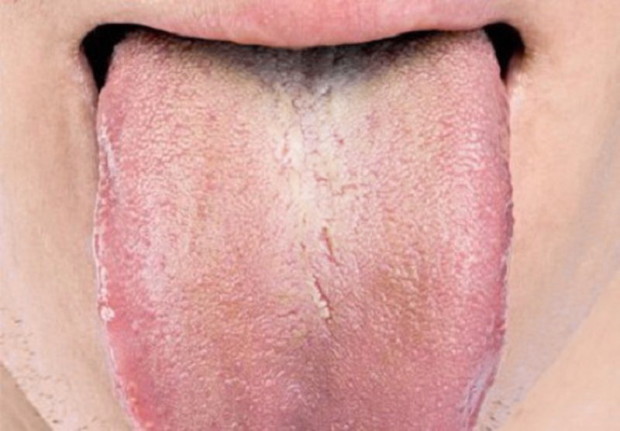 Belyj yazyk - Причины неприятного запаха изо рта и как от него избавиться?